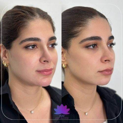 فیلر