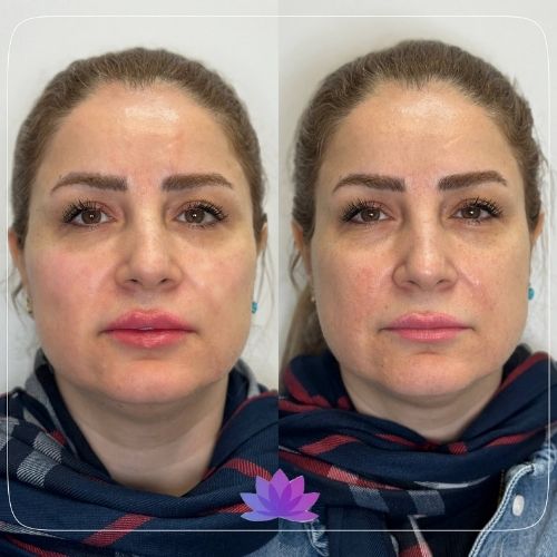 فیلر