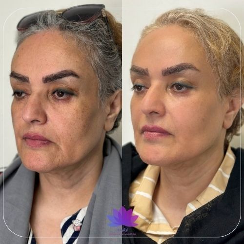 اندولیفت