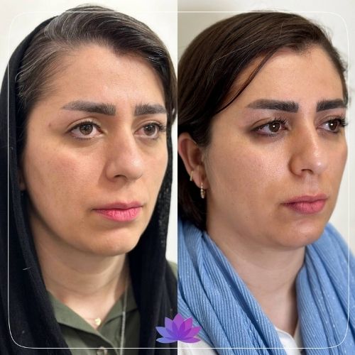 اندولیفت