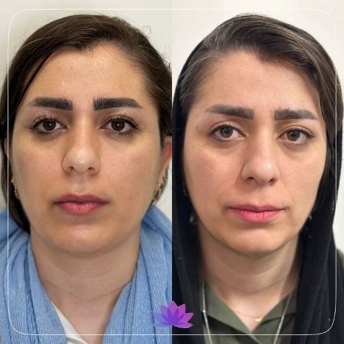 اندولیفت