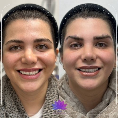 بوتاکس