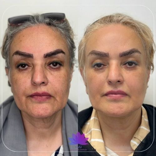اندولیفت