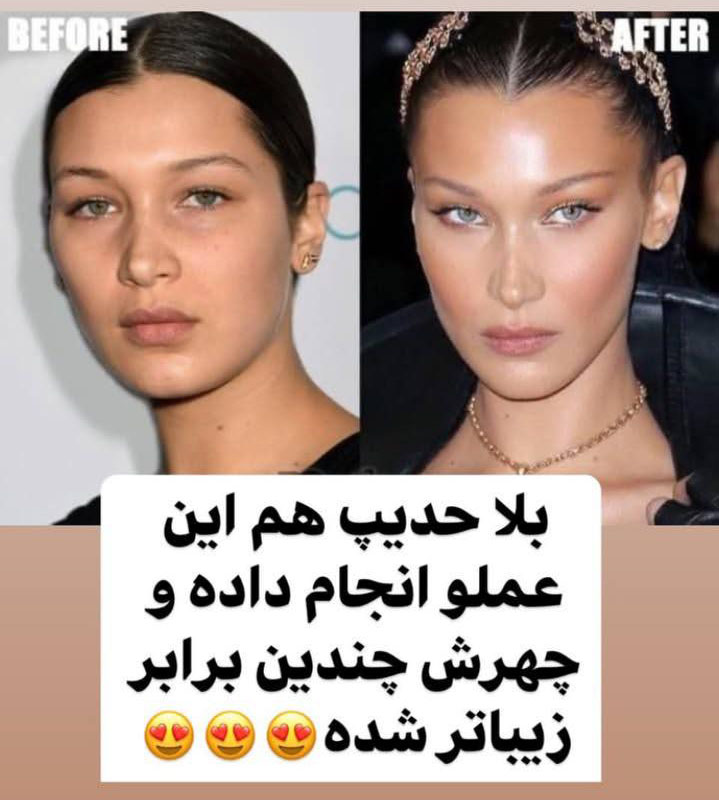 عمل لیفت شقیقه بلا حدید