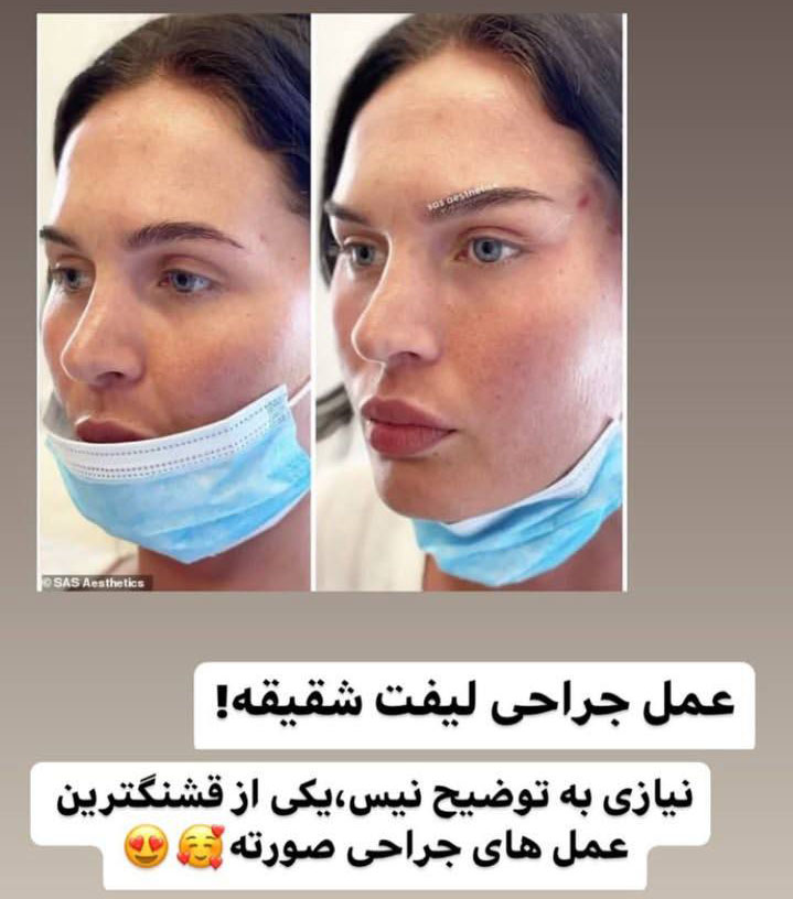 عمل جراحی لیفت شقیقه