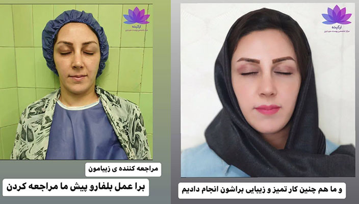نتیجه بلفاروپلاستی
