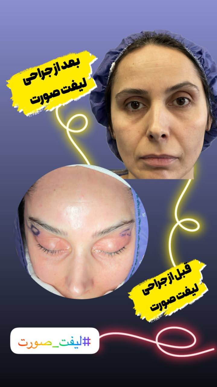قبل و بعد لیفت صورت