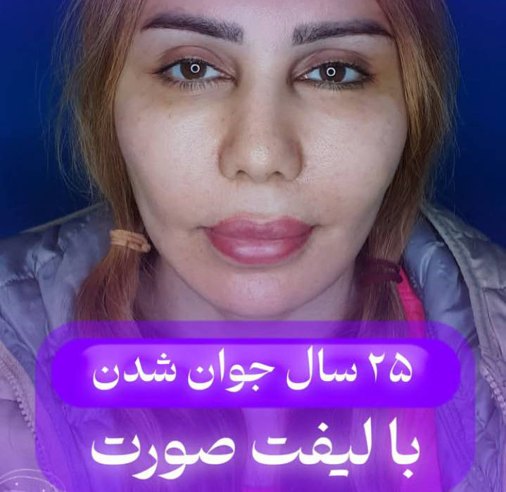 ۲۵ سال جوان شدن با لیفت صورت